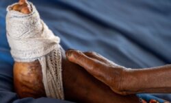 2025 03 07t085343z 1 lynxnpel260bz rtroptp 3 nigeria health leprosy